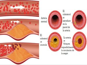 ateroesclerosis